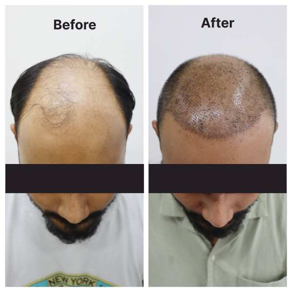 Hair Transplant result KOQ10